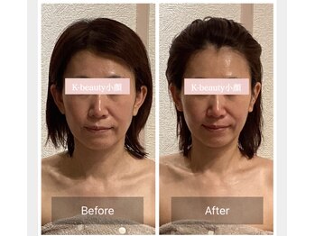 ケービューティー 小顔(K-beauty)/小顔コルギ