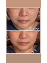 ソルテケア(SORTE*care)/美顔「πフェイシャル」