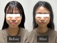 ベルフィーヌ 恵比寿店(BELFINE)/【造形小顔】施術の経過