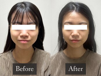 ベルフィーヌ 恵比寿店(BELFINE)/【造形小顔】施術の経過