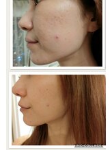 アゴラ/【小顔】ハーブピーリング１回目