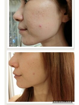 アゴラ/【小顔】ハーブピーリング１回目