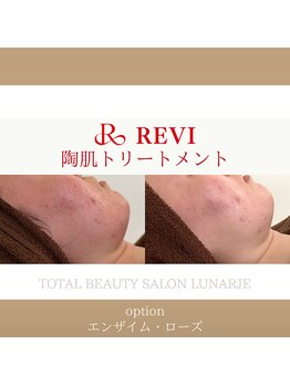 ルナージュ(LUNARJE)/陶肌トリートメント