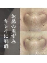 ラエッセ(LAESSE)/ブラックピーリング&毛穴吸引