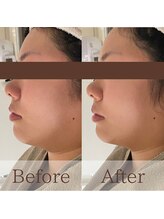 凪眠/小顔リンパフェイシャルの効果78