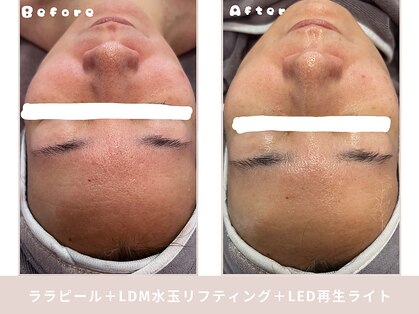 バブルビューティー(Bubble beauty)の写真