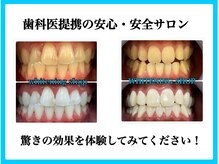 ホワイトニング ショップ 金沢店の雰囲気（【歯科提携】効果は歴然！独自開発のジェルを体験してください！）