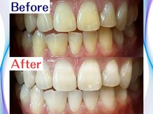 LBSホワイトニング 新宿店/ホワイトニングビフォーアフター