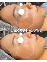 ラティーナ(Lattina)/陶肌ピール