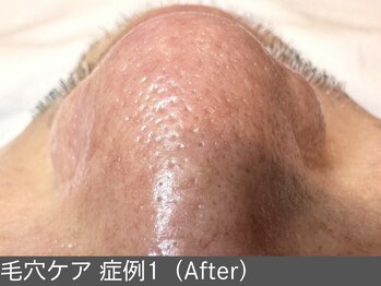 オアシスラグーン(OASIS LAGOON)/毛穴ケア(症例1 after)