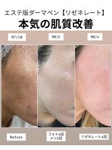 エイチケービューティーサロン(H/K beauty salon)/とにかく【本気の肌質改善】