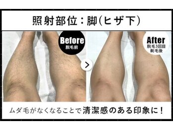 RBL 甲府昭和店/メンズ脱毛/ヒザ下3回目剃毛後