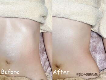 ボディーリセット 勝どき/【before/after】エステ・痩身