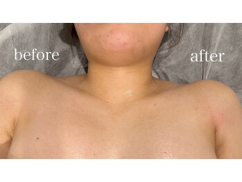 チル(chill)/肩のお悩みも解決！