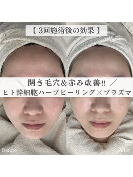 イロハ(IROHA)/幹細胞ピーリング×プラズマ