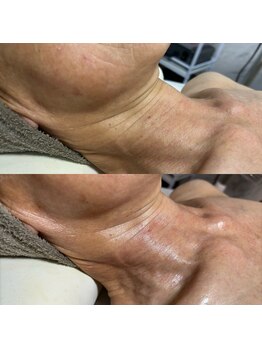 アヌヘア(Anuhea)/首ケアにもプラズマニア