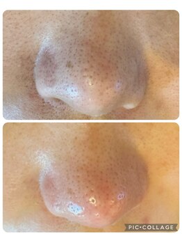 オゾンレメディ(O3remedy)/毛穴洗浄