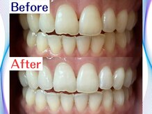LBSホワイトニング 新宿店/ホワイトニングビフォーアフター