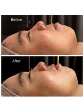 エヌア(nA)/【ニキビ特化】コモデックス！