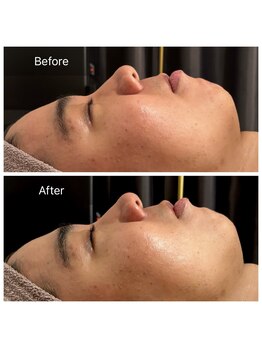 エヌア(nA)/【ニキビ特化】コモデックス！