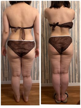 ベルミナ(Belmina)/大名/天神/毛穴/脱毛/痩身