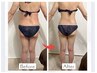 【リピーター様人気No. 1】さらに脂肪冷却.5000円引きクルスカダブルダブル