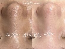 レシェルサロン(Lechelle Salon)の雰囲気（ハーブピーリング歴20年　実績・症例2万件超★トップ技術者）