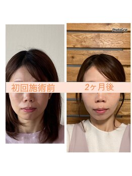 リフェイスフサエ(ReFace Fusae)/お顔の変化