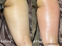 ボディーリセット 勝どき/【before/after】エステ・痩身