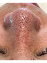 ルチル(Rutile)/韓国式3D毛穴洗浄