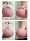 巻き爪ケア