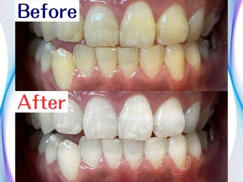 LBSホワイトニング 新宿店/ホワイトニングビフォーアフター