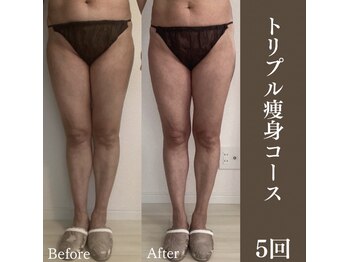 サロンドペシェ(salon de peche)/トリプル痩身コース5回の変化