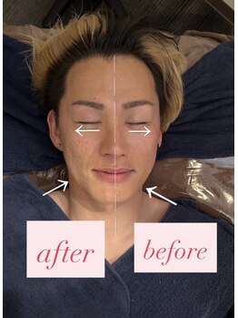 ソルテケア(SORTE*care)/美顔「πフェイシャル」