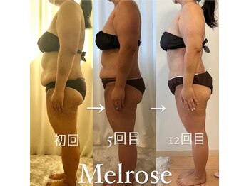 Melrose 銀座店 【メルローズ】/【お客様の効果写真】