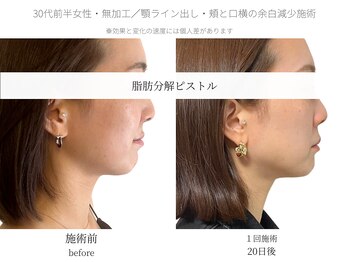 サボラミ(sabor A Mi)/一回の施術での変化です◎