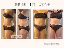 ビーサロン(B-salon)/脂肪冷却1回の変化例