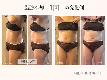 ビーサロン(B-salon)/脂肪冷却1回の変化例