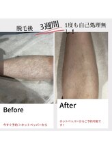 クエピ(QuEpi)/メンズ脱毛before＆after【脚】