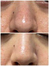 Ms.やまとなでしこ/BBLフェイシャル鼻の黒ずみ