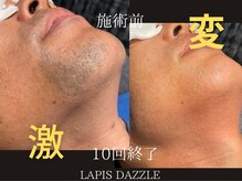 ラピスダズル(LAPIS DAZZLE)/ひげ脱毛☆途中経過(10回終了後)