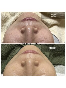 わきさか鍼灸整骨院・鍼灸院 レーヴ(Reve)/定期的なケアで変化実感!