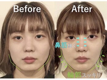 ラプリアンジュ 鹿児島天文館店(Raplit ange)/隆鼻+輪郭矯正40分10回