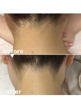 メゾン ド クロエ(Maison de Chloe)/ブライダルシェービング