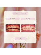 プラスビー 2号店(+b)/ホワイトニングビフォーアフター