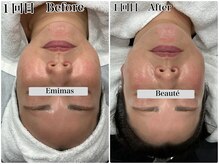 エミマス ボーテ(Emimas Beaute’)/４０代前半　小顔矯正＆毛穴洗浄