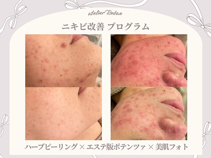 アトリエリュバン 梅田店(atelier Ruban)の写真