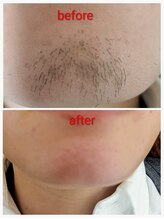 ヌケッタ 池袋/ヒゲ脱毛