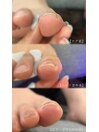 巻き爪ケアジェルの効果*
