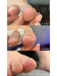 巻き爪ケアジェルの効果*